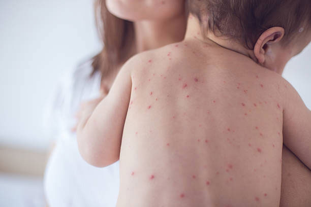 Children chickenpox treatment in vijayawada