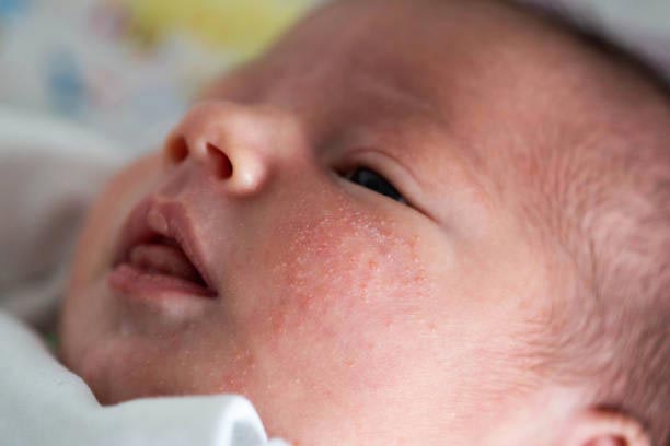 newborn baby rash